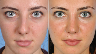 Antes e depois septoplastia mulher