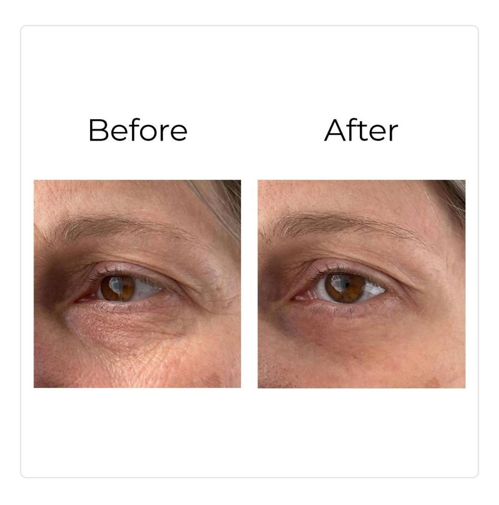 Miniatiūra: PEPTILUX - ANTI-WRINKLE 'SHOCK ACTION EFFECT' EYE CONTOUR CREAM WITH LIPHASYN™ -