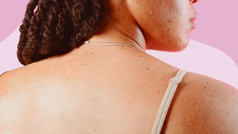 Skin Tag Removal