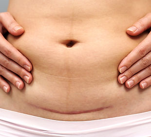 scar reduction_edited.jpg