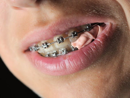 Can Braces Cause a Sore Throat?