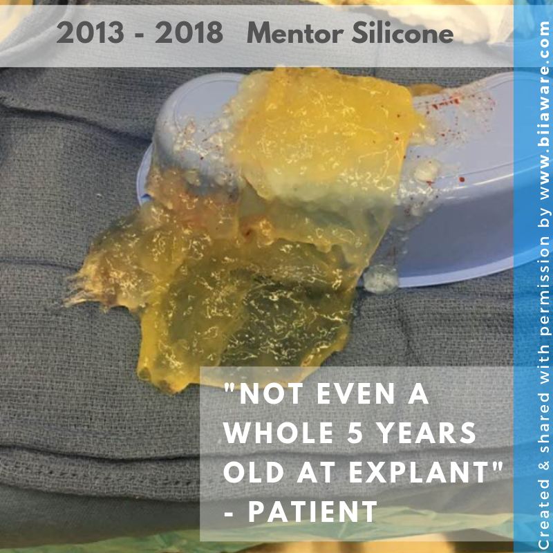 Ruptured 5 year old Mentor Silicone (Highly cohesive aka gummy bear) breast implant