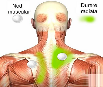 nodul-muscular-durere-radiata