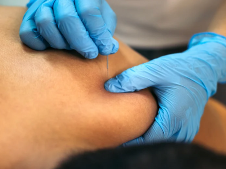 Beneficiile Dry Needling (terapia cu ace uscate) pentru durere de spate și recuperarea musculară