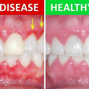Bleeding gums and broken breathing
