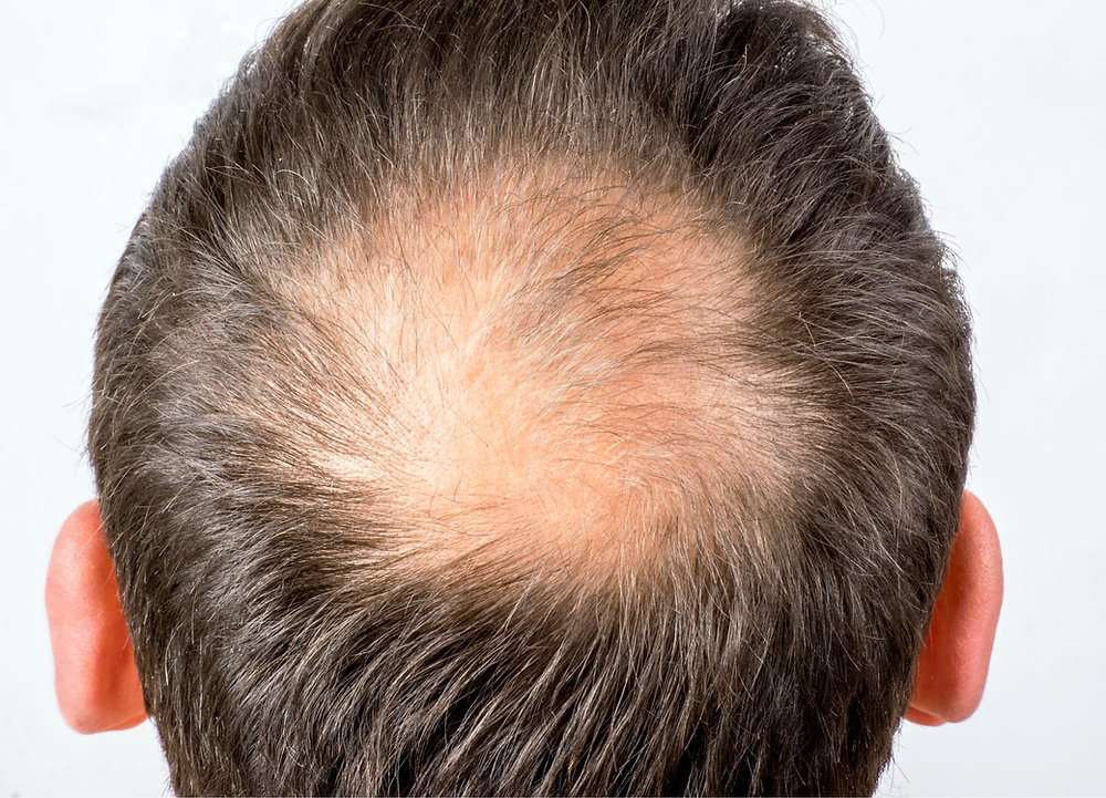 White man with visible crown thinning illustrating pattern hair loss