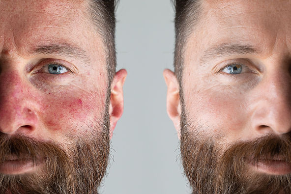 Face of a man with flushed cheek skin. Before and after a rosacea laser treatment. Half fa