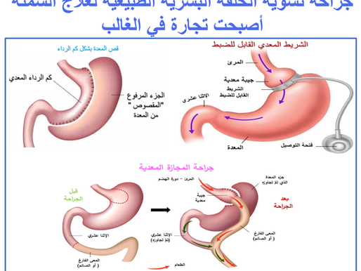 السمنة المرضية ودواعي ومخاطر إجراء تقليص المعدة الجراحي أو الجراحة البَرياتيكية