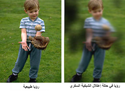 مضاعفات الداء السكري المزمنة على العينين  (Chronic diabetic eye complications)