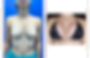 AUMENTO MAMARIO CASO 3.png