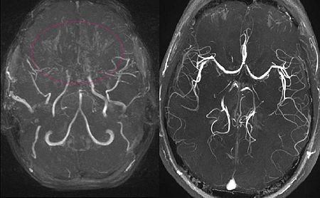The Scan That Spoke: A Patient’s Journey With MRI Technology and Moyamoya Disease