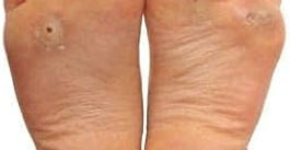 VIRAL WARTS, CORN, CALLOUS & SKIN TAGS