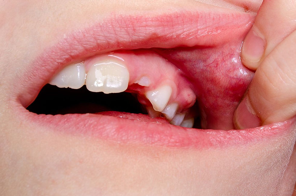 خراج الأسنان هو عبارة عن تجمع لصديد يتطور داخل الأسنان أو اللثة