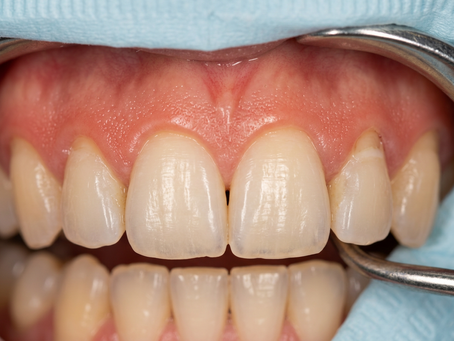 Gum Recession: Early Causes & Treatment Before Tooth Loss