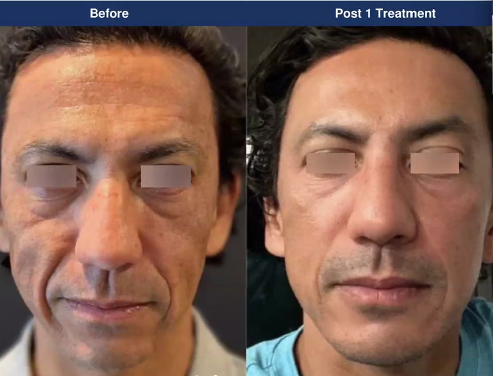 Customized UltraClear Treatment