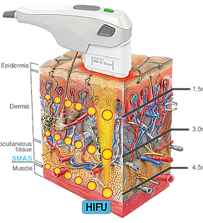 HIFU