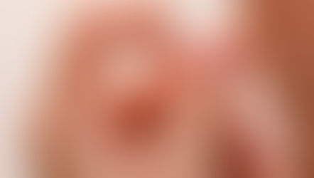 How Hypnotherapy Helped Me Control the Urge to Pick My Skin and Manage Stress