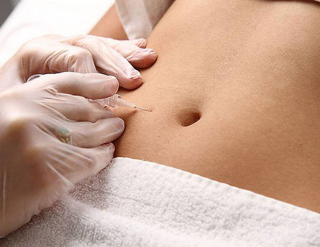 Carboxiterapia 