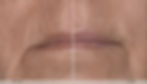 Before and after EXION treatment showing reduced vertical lip lines and smoother skin around the mouth.