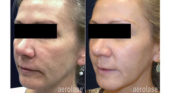 Neo Rejuvenation - After 4 Treatments - Kevin Pinski MD.jpg