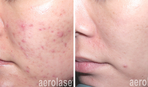 aerolase-acne-spade-before-after-watermark-6-treatments.png