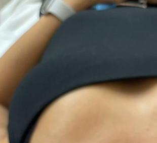 Tratamiento de microdermoabrasión para renovar la piel y estimular el colágeno.