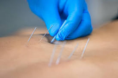 dry needling image.jpg