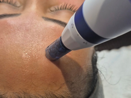 Boosting Skin Health with Exosome Microneedling