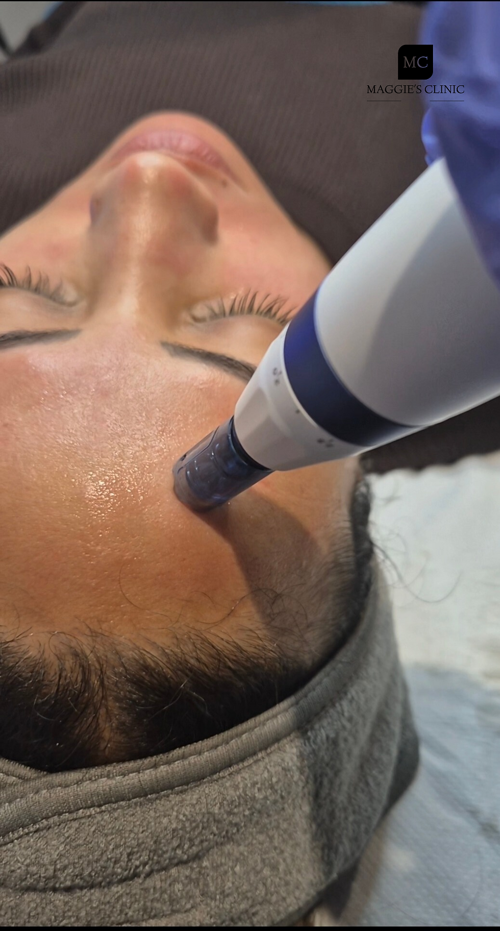 Close-up view of microneedling device with serum being applied