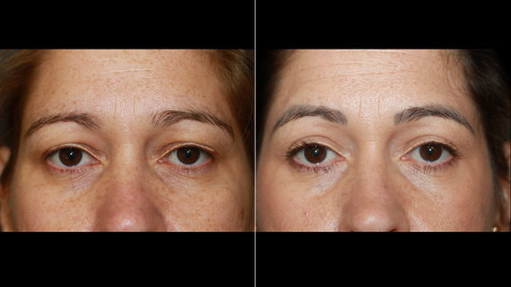 Eyelid Surgery, Blepharoplasty, Soler Baillo Plastic Surgery