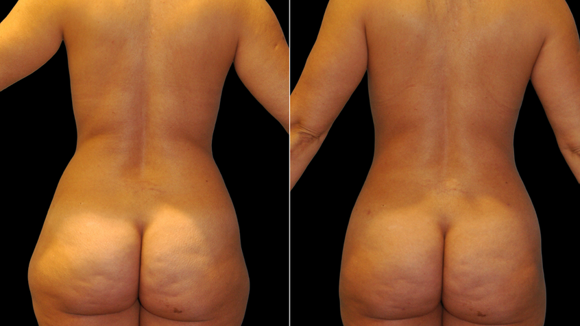 Liposuction in Coral Gables by Dr. Soler Baillo