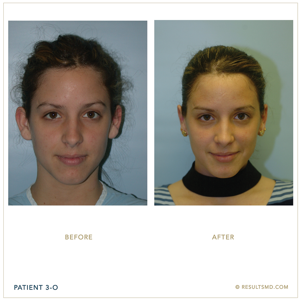 Patient 3 - OTOPLASTY - V1