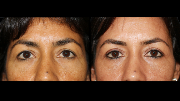 Eyelid Surgery, Blepharoplasty, Soler Baillo Plastic Surgery
