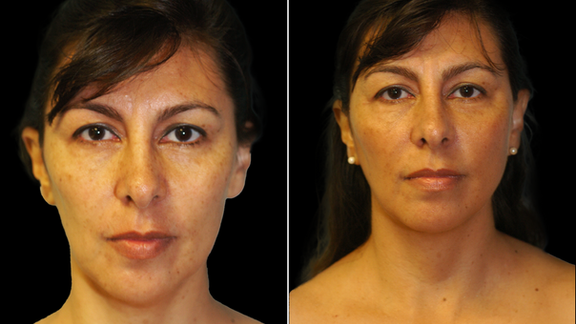 The Angle, Chin Liposuction, Soler Baillo Plastic Surgery, Coral Gables Miami