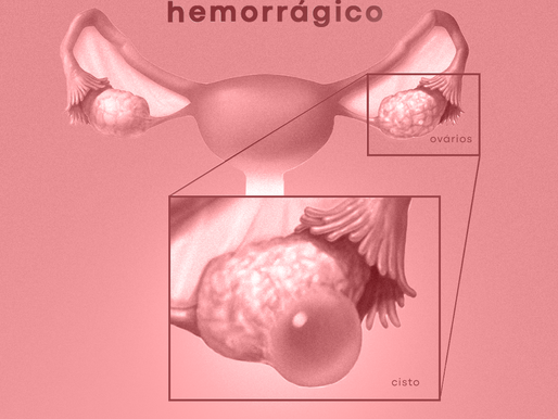 Cisto ovariano hemorrágico