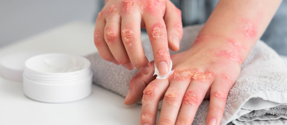 Atopic dermatitis (AD), also referred to as eczema, is a chronic inflammatory skin disease that affects millions of individuals globally. With features of red, itchy, dry, and inflamed skin, eczema can have a serious effect on an individual's quality of life. Although it is most prevalent in children, it can occur in anyone at any age.