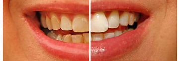 Pola Home Teeth Whitening Before and after