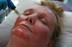 Medical Skin Needling