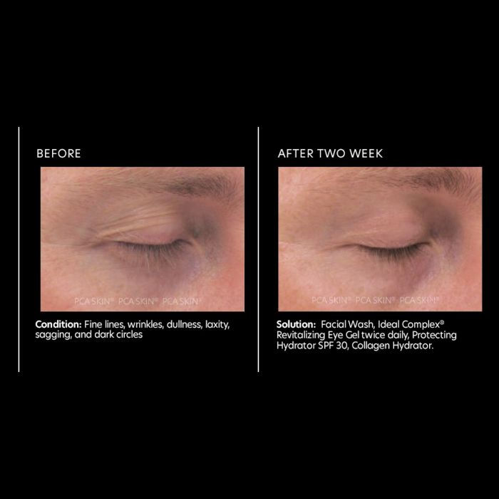 Thumbnail: PCA Ideal Complex® Revitalizing Eye Gel