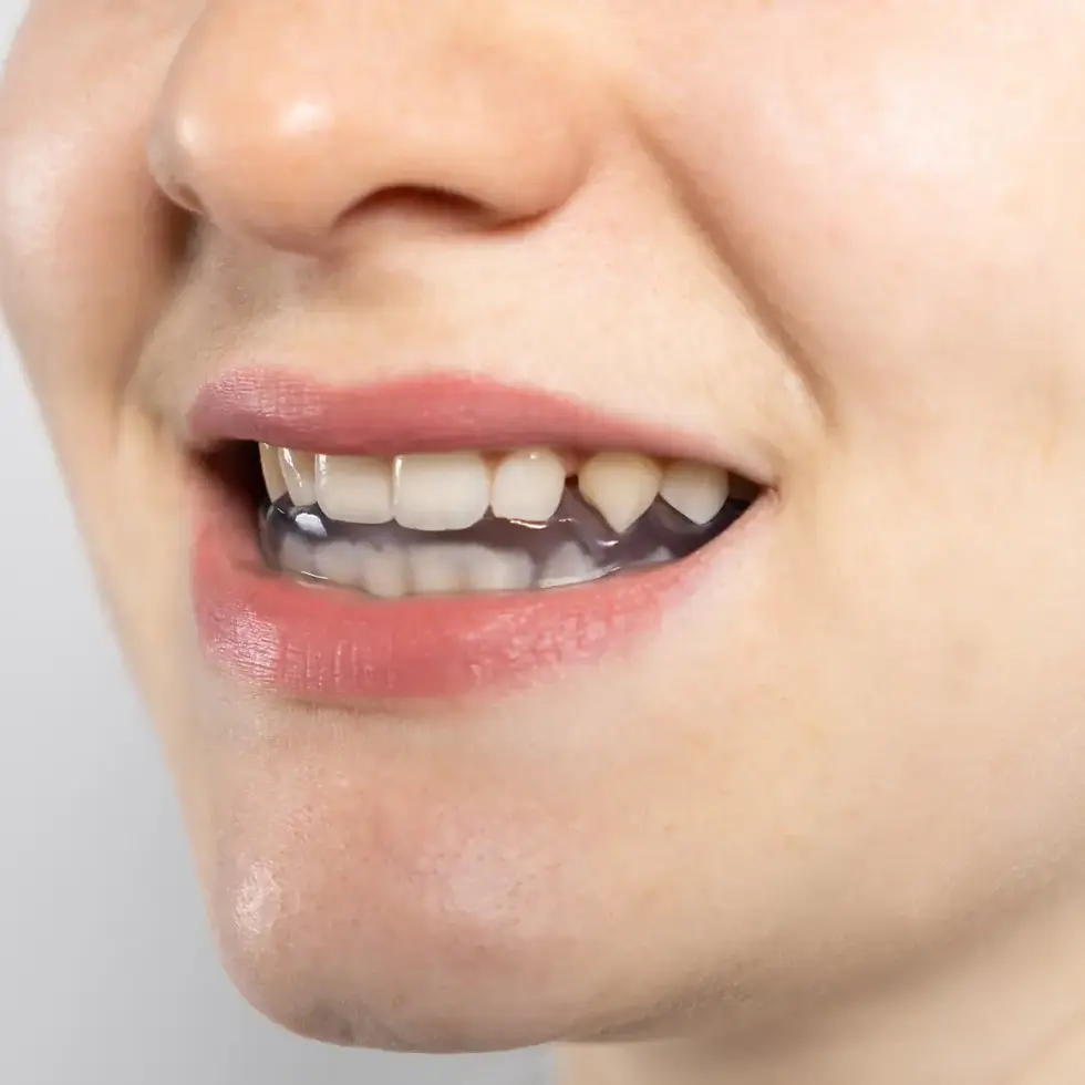 splint nedir
