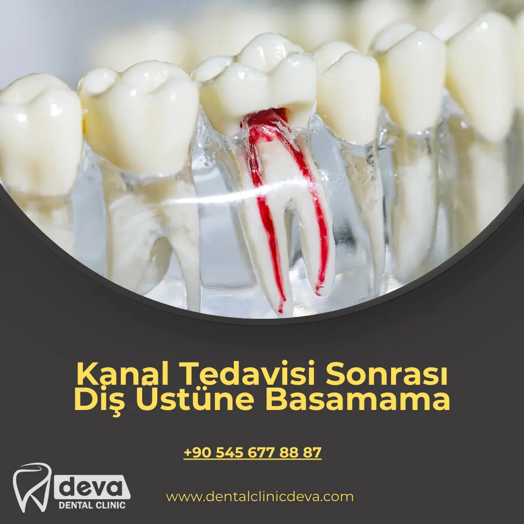 Alveolit-Diş çekiminden sonra iltihaplanma evde tedavi