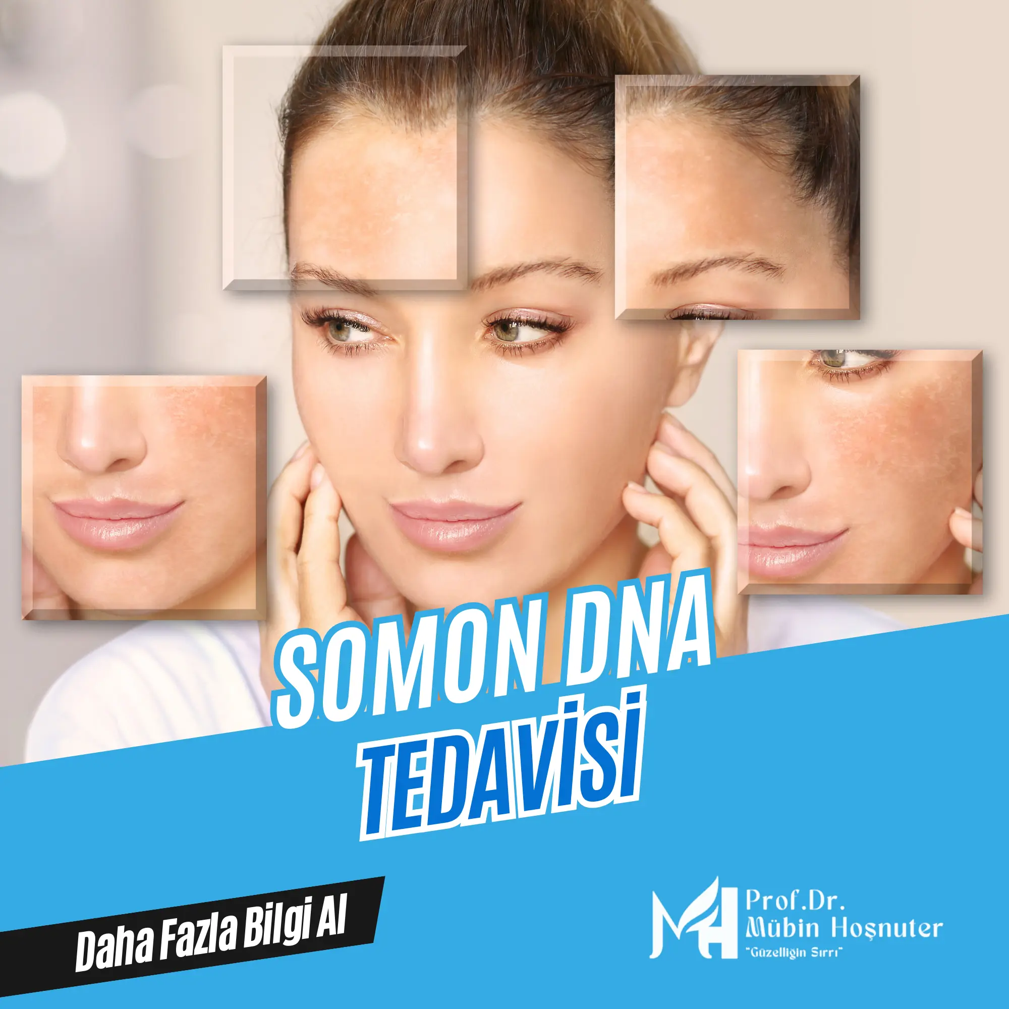  radiesse nedir