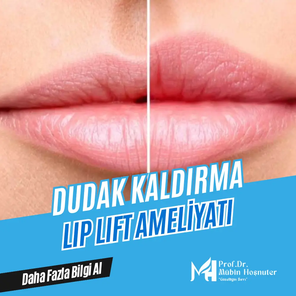 radiesse dolgu