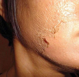 medical skin peel