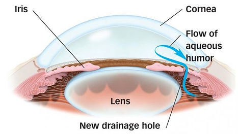ea-glaucoma-laser-iridotomy-2-638x360.jpg