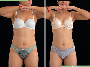 Before and After of white female from the front after truBody treatment series.