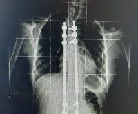 Implantes Magnéticos: