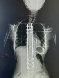 Implantes Magnéticos: