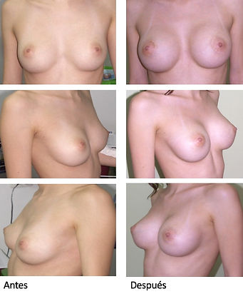 Mamoplastia Colombia Antes y Despues