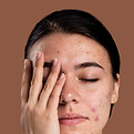 Forehead acne scar treatment at Skin and Slim Medical Center Abu Dhabi to reduce boxcar scars and pigmentation